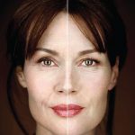Blepharoplasty-zatezanje kapaka i podočnjaka
