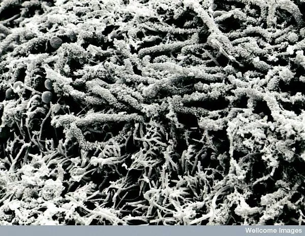 Naslage na zubima Elektronski mikroskop slike ćelije unutar tela Naslage na zubima Elektronski mikroskop slike ćelije unutar tela