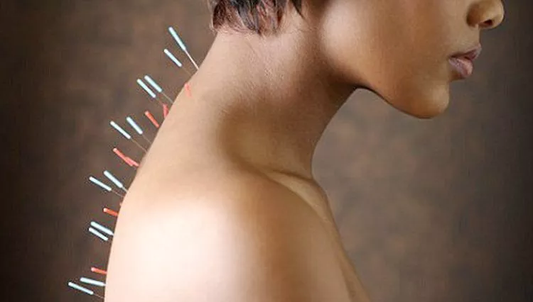 Kineska medicina i akupunuktura Kineska medicina i akupunuktura