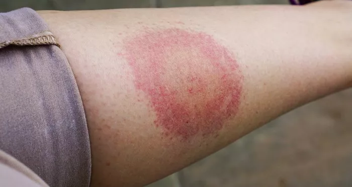 Šta je Lajmska bolest ili Evropska Borelioza i ubod zaraženog krpelja