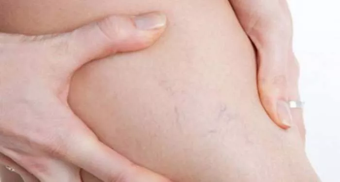 Proširene vene i lečenje proširenih vena Proširene vene i lečenje proširenih vena