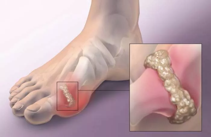 Giht - lečenje gihta, lekovi, ishrana i dijeta za giht Giht - lečenje gihta, lekovi, ishrana i dijeta za giht
