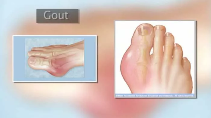 Kako izlečiti giht na brz i efikasan način - lekovi za giht Kako izlečiti giht na brz i efikasan način - lekovi za giht