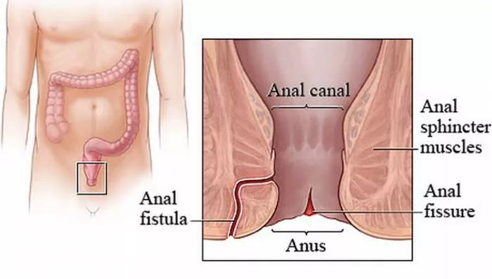 Analna fisura i fistula - BioBalsam je krema za fistulu i krema za fisuru Analna fisura i fistula - BioBalsam je krema za fistulu i krema za fisuru