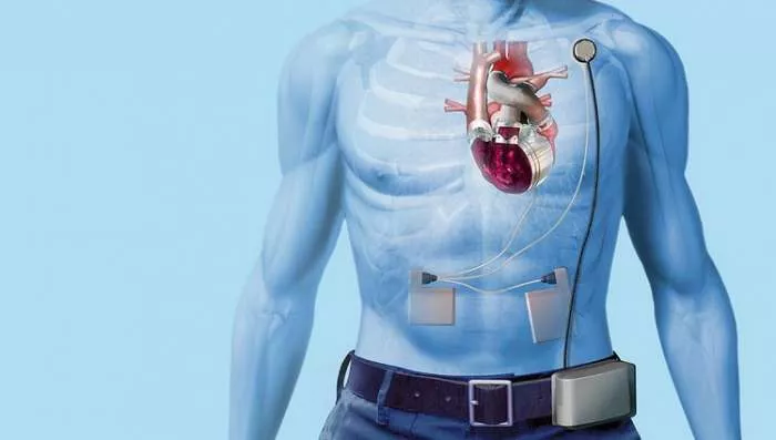 Kako radi veštačko srce Kako izgleda ugradjeno veštačko srce