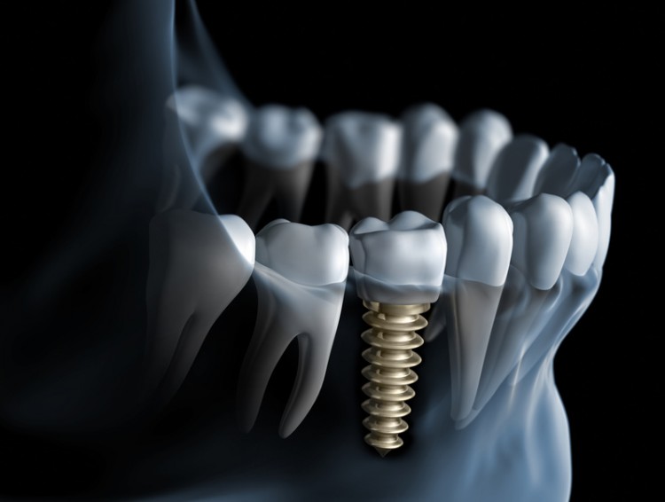 zubni implant