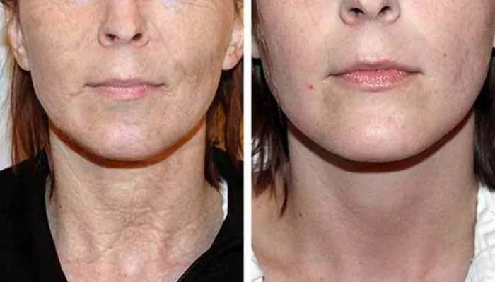 Tretman bora rezultati Tretman bora rezultati