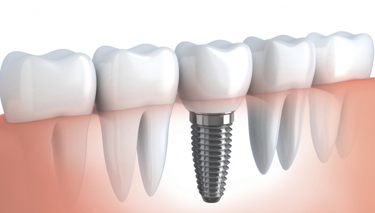 Tooth human implant (done in 3d graphics)