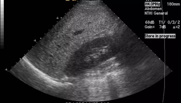 Prirodni lek za masnu jetru - kao se leči masna jetra Prirodni lek za masnu jetru - kao se leči masna jetra