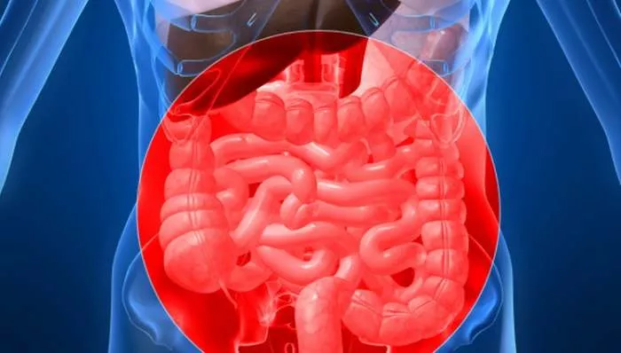 Upala creva i Šta je Kronova bolest i Ulcerozni kolitis - dijagnoza i lečenje Krona Upala creva i Šta je Kronova bolest i Ulcerozni kolitis - dijagnoza i lečenje Krona