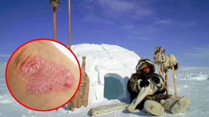 eskimi nemaju psorijazu