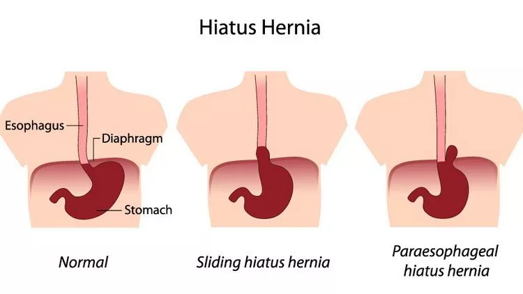 Želudačna kila i kako da spustite želudac – Vežbe za nameštanje želuca Hiatu hernia Želudačna kila i kako da spustite želudac – Vežbe za nameštanje želuca Hiatu hernia