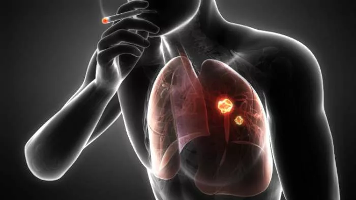 genske mutacije na plućima