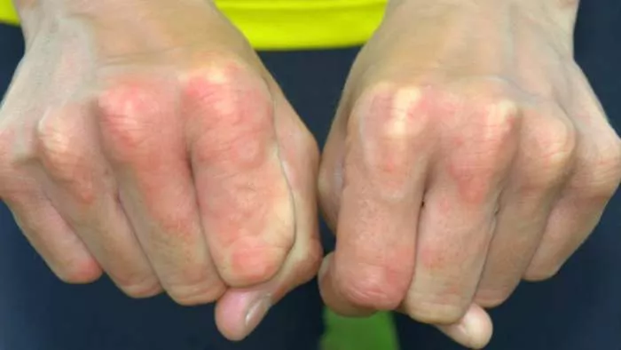 slaba cirkulacija u prstima