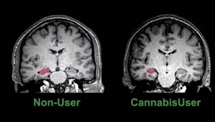 Marihuana i mozak - Štetan uticaj marihuane na cirkulaciju krvi u mozgu Marihuana i mozak - Štetan uticaj marihuane na cirkulaciju krvi u mozgu
