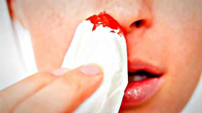 jutarnje krvarenje iz nosa