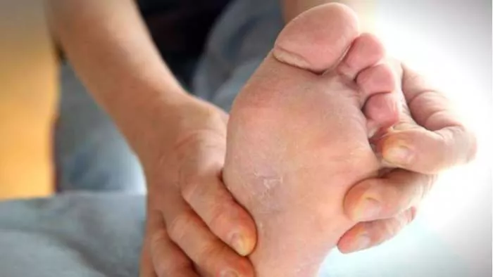 ljuštenje stopala