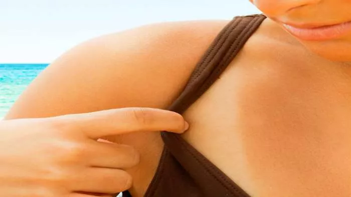 svrab posle sunčanja