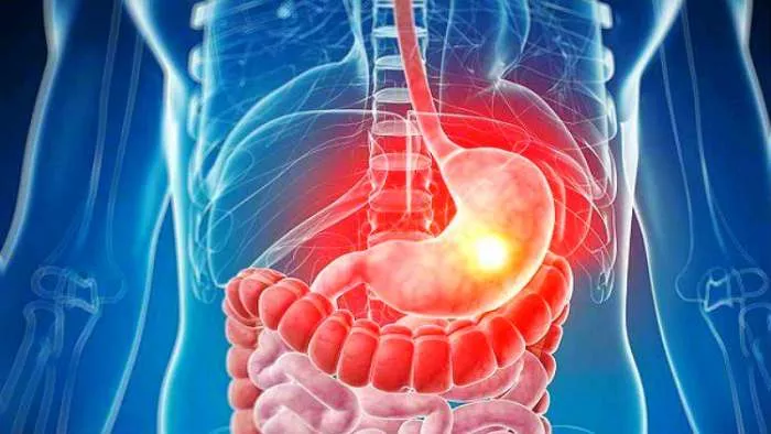 ishrana kod gastritisa