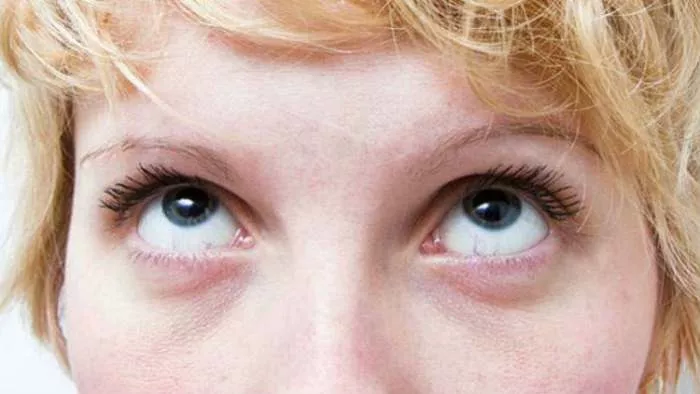 podočnjaci plavuša