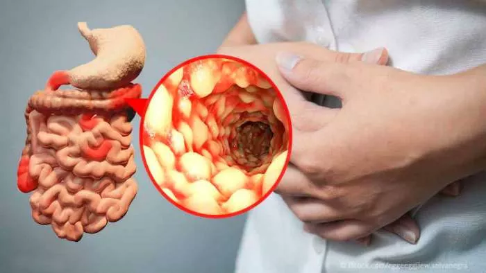 ishrana kod kronove bolesti