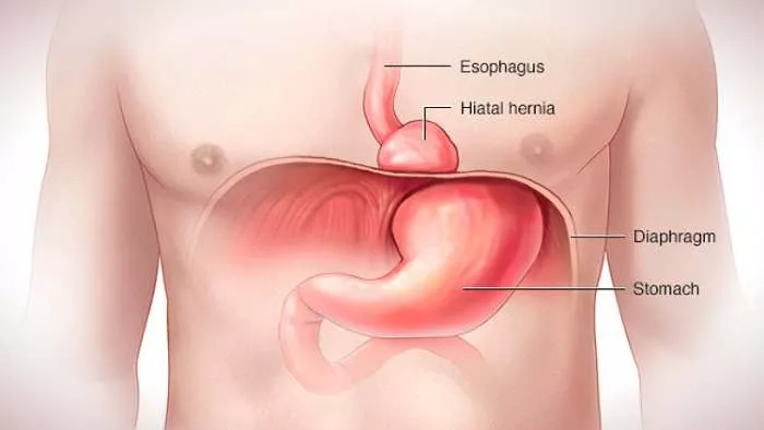 ishrana kod želudačne kile