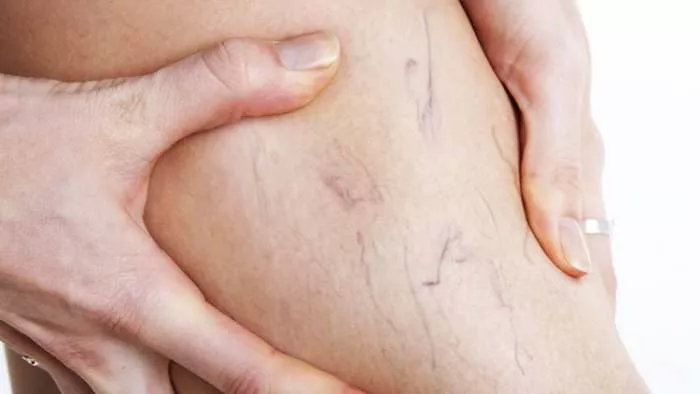 Kako nastaju ispucali kapilari uzroci i lečenje ispucalih kapilara Kako nastaju ispucali kapilari uzroci i lečenje ispucalih kapilara