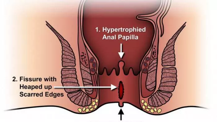 Šta je fisura, kako nastaje analna fisura i kako se leče fisure anal fissure Šta je fisura, kako nastaje analna fisura i kako se leče fisure anal fissure