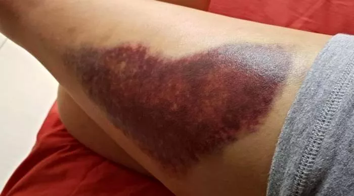 modrice posle operacije