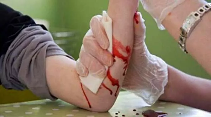 brzo zaustaviti krvarenje