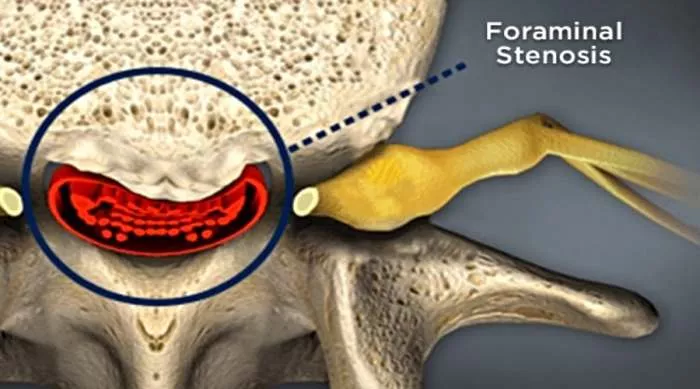 neuralna foraminalna stenoza
