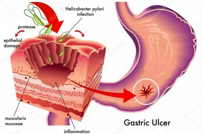 Šta je Ulkus ili čir na želucu, dvanaestopalačnom crevu i u digestivnom traktu Šta je Ulkus ili čir na želucu, dvanaestopalačnom crevu i u digestivnom traktu