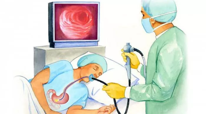 Šta je gastroskopija kao metoda pregleda želuca i ko ide na gastroskopiju Šta je gastroskopija kao metoda pregleda želuca i ko ide na gastroskopiju