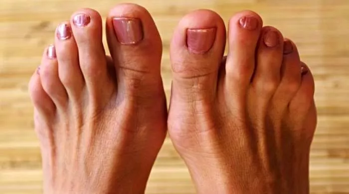 ispraviti nožne prste