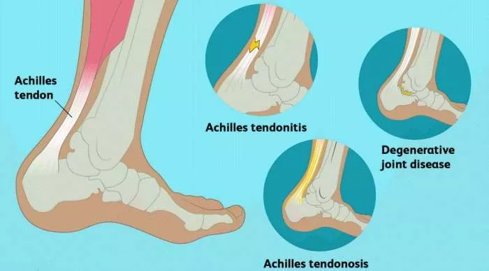 Šta je Ruptura Ahilove tetive (tendo Achillis) - šta kad pukne Ahilova tetiva Šta je Ruptura Ahilove tetive (tendo Achillis) - šta kad pukne Ahilova tetiva