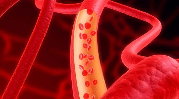 čišćenje arterija
