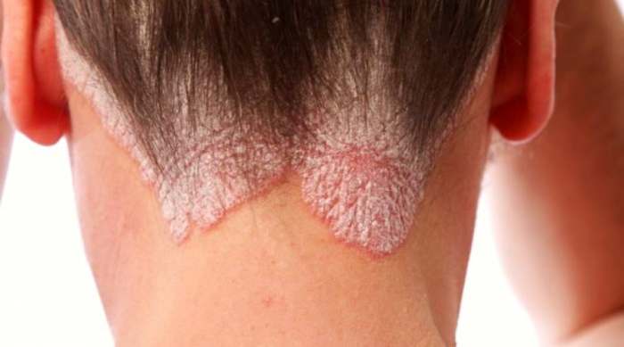 kosa psorijaza