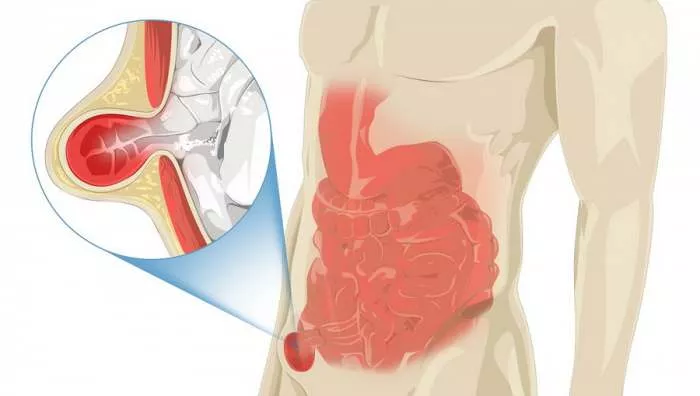 Želudačna kila - Koji su simptomi, kako da je prepoznate?
