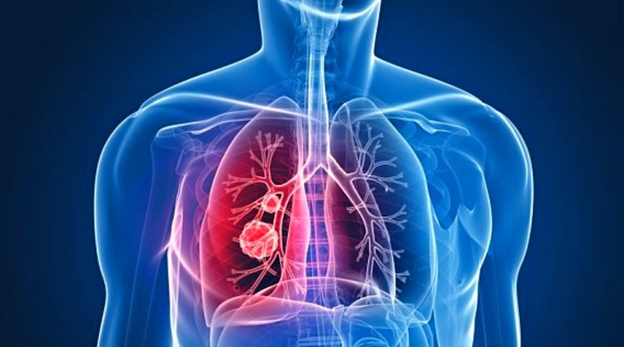 pneumonija