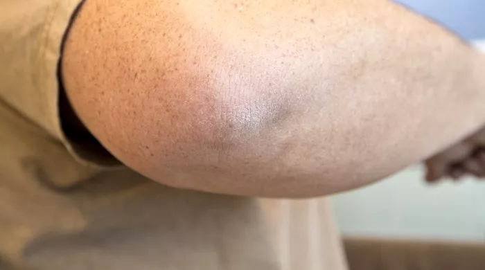 suva koža na laktovima