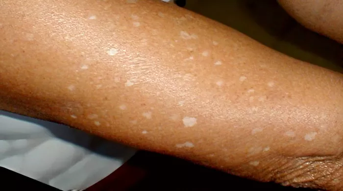 idiopatska guttata hipomelanoza