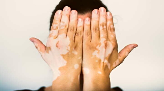 vitiligo