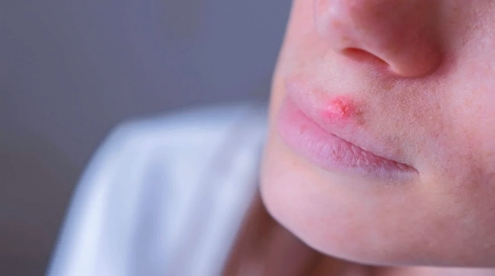 herpes