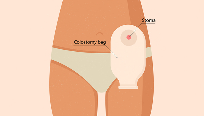 Stoma na stomaku - koja je uloga, koje vrste postoje i komplikacije?