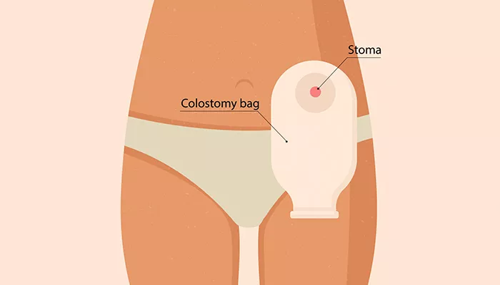 Stoma na stomaku - koja je uloga, koje vrste postoje i komplikacije?