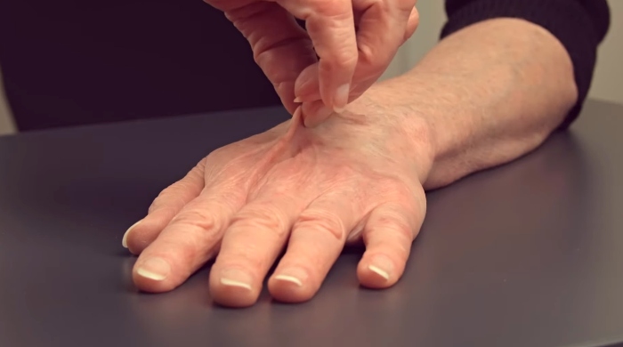 skin turgor